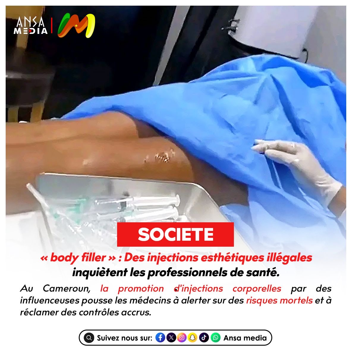BODY FILLER AU CAMEROUN : des injections esthétiques illégales inquiètent les professionnels de santé.